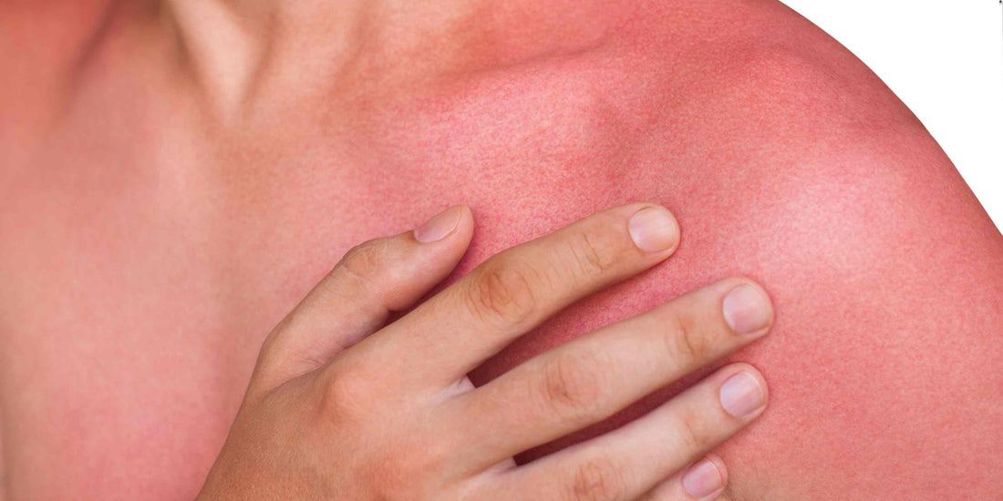 Sunburn | The Tallow Co,